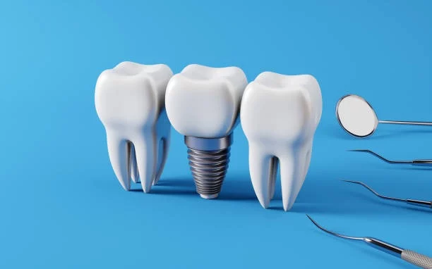 When Tooth Implants Go Wrong